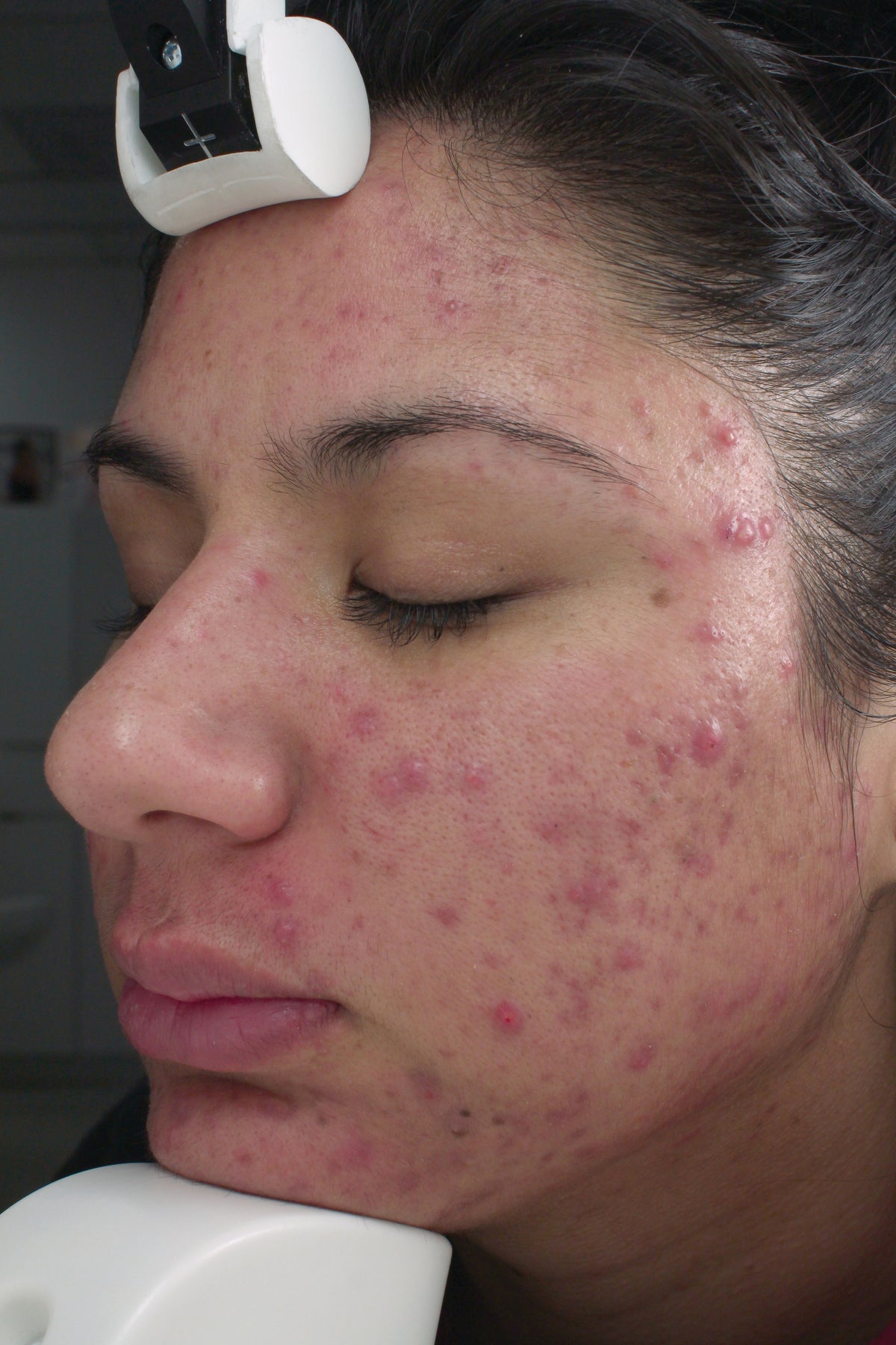 Fight Acne & Aging