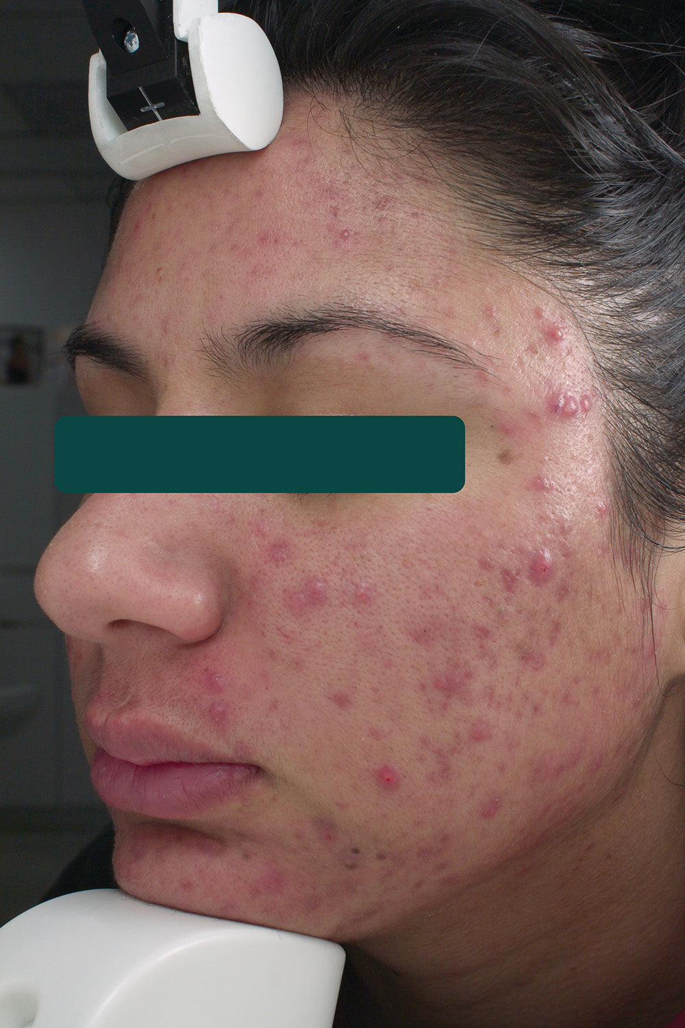Fight Acne & Aging
