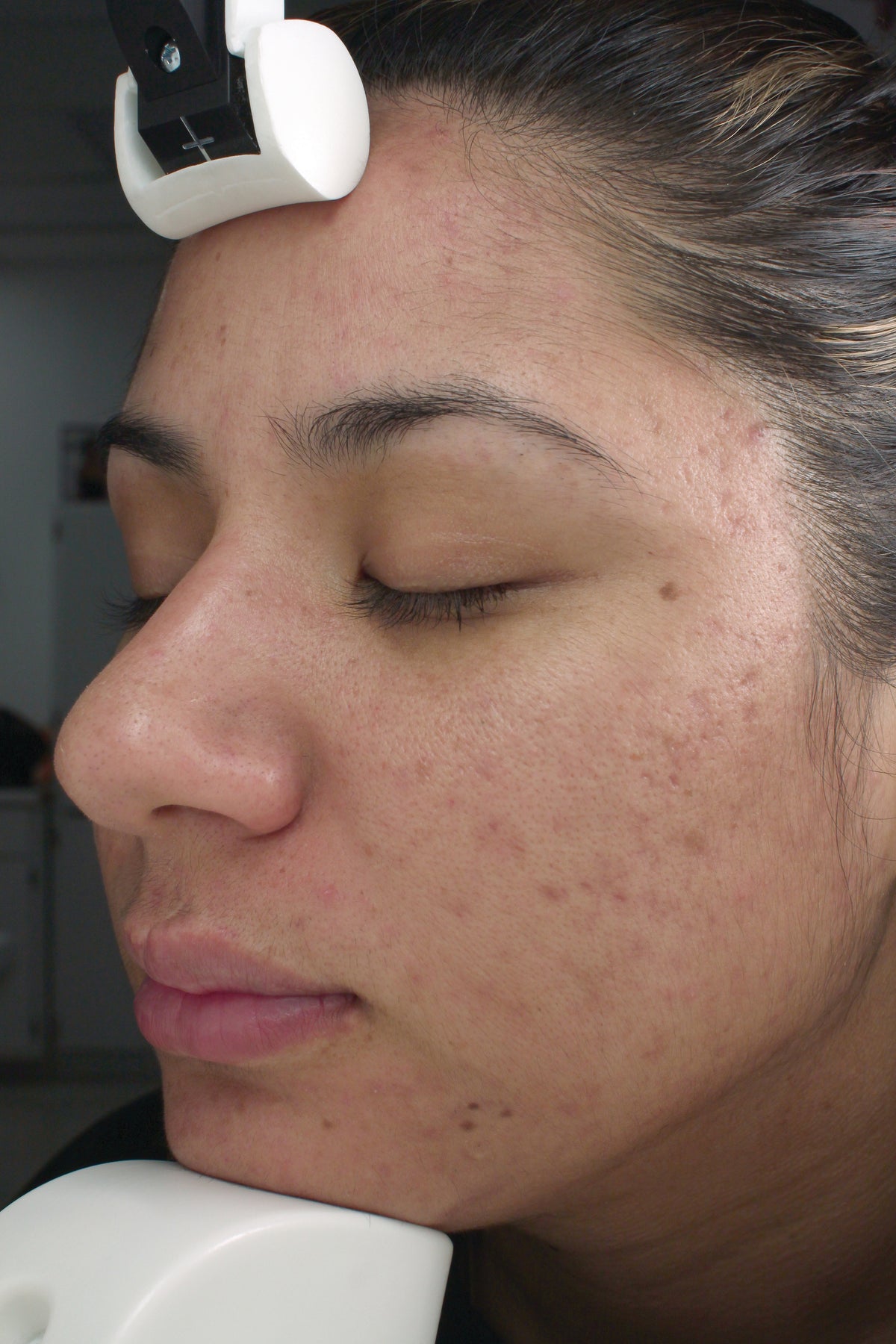 Fight Acne & Aging
