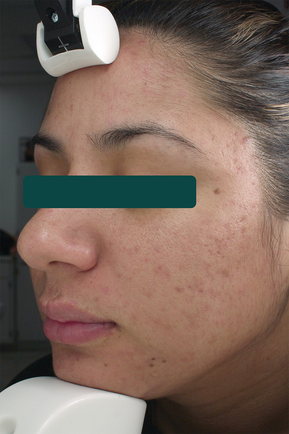 Fight Acne & Aging