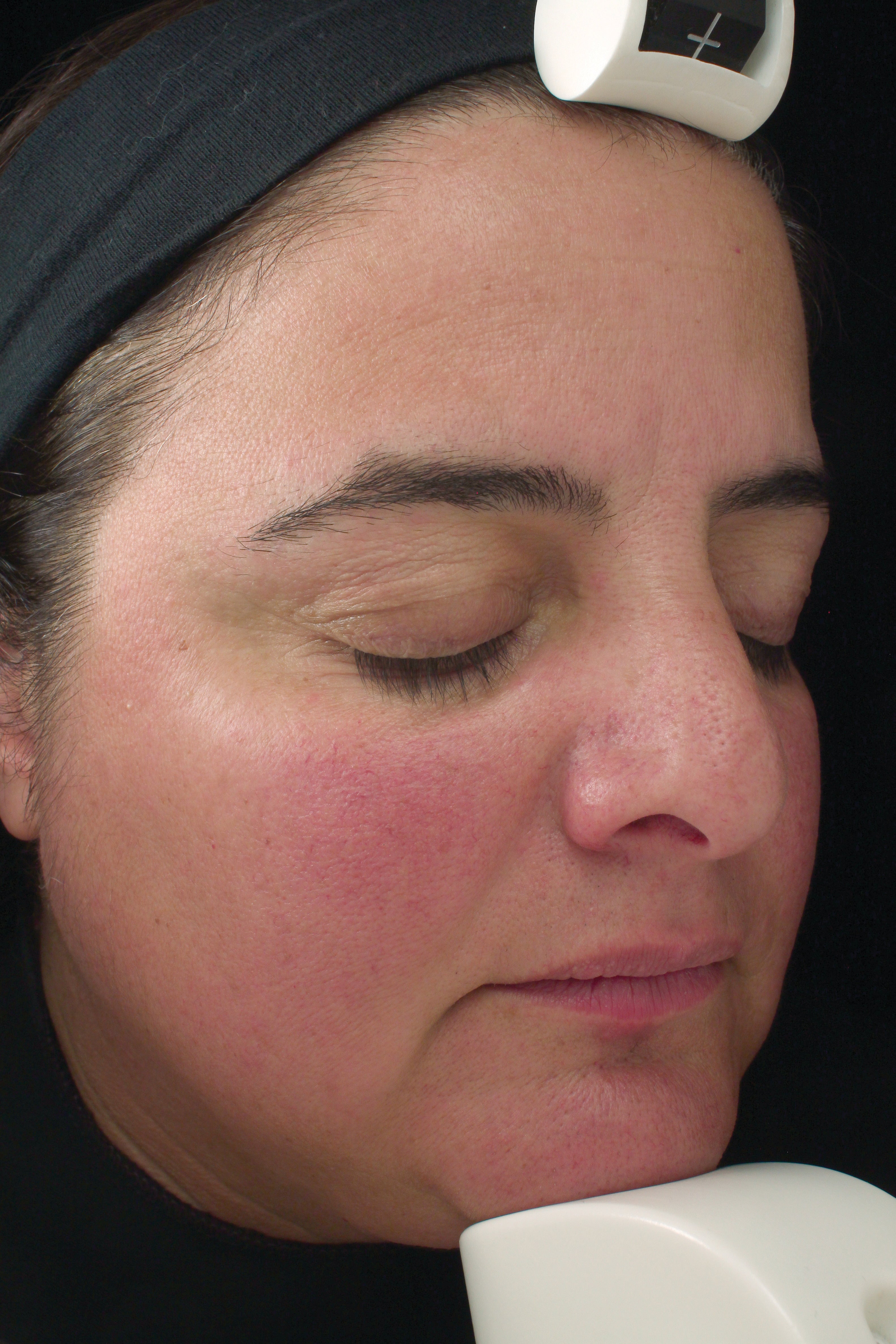 RosaLieve® | Reduce Face Redness with Clinically Proven Skin Care