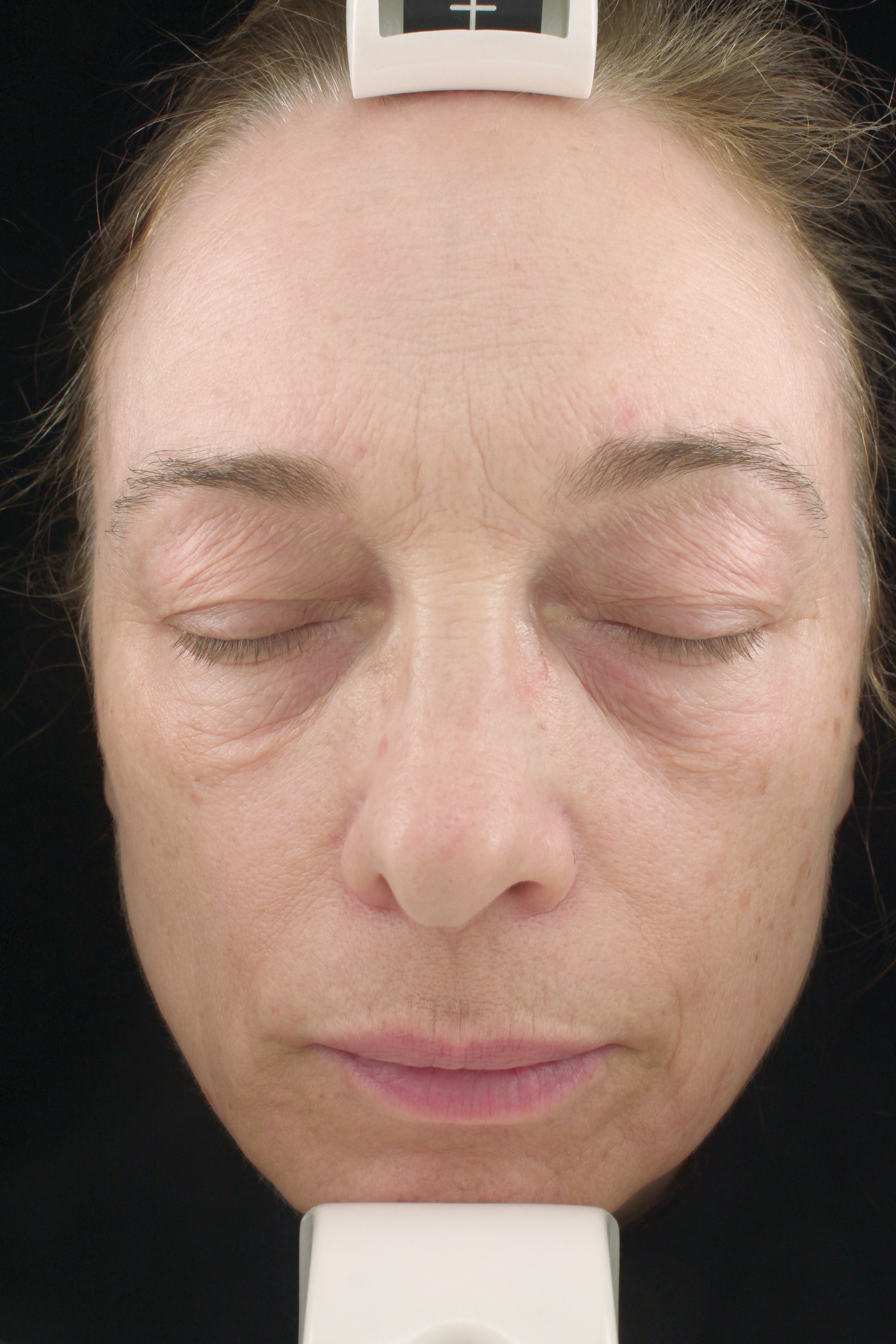 Hyla3D® Face Serum | Hyaluronic Acid HA | Facial Volume