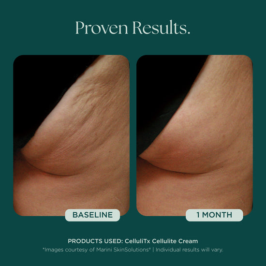 Before and after comparison of cellulite treatment with 1 month results. Clinically proven skin care product used: CelluliTX Cellulite Body Cream from Marini SkinSolutions