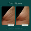 Before and after comparison of cellulite treatment with 1 month results. Clinically proven skin care product used: CelluliTX Cellulite Body Cream from Marini SkinSolutions