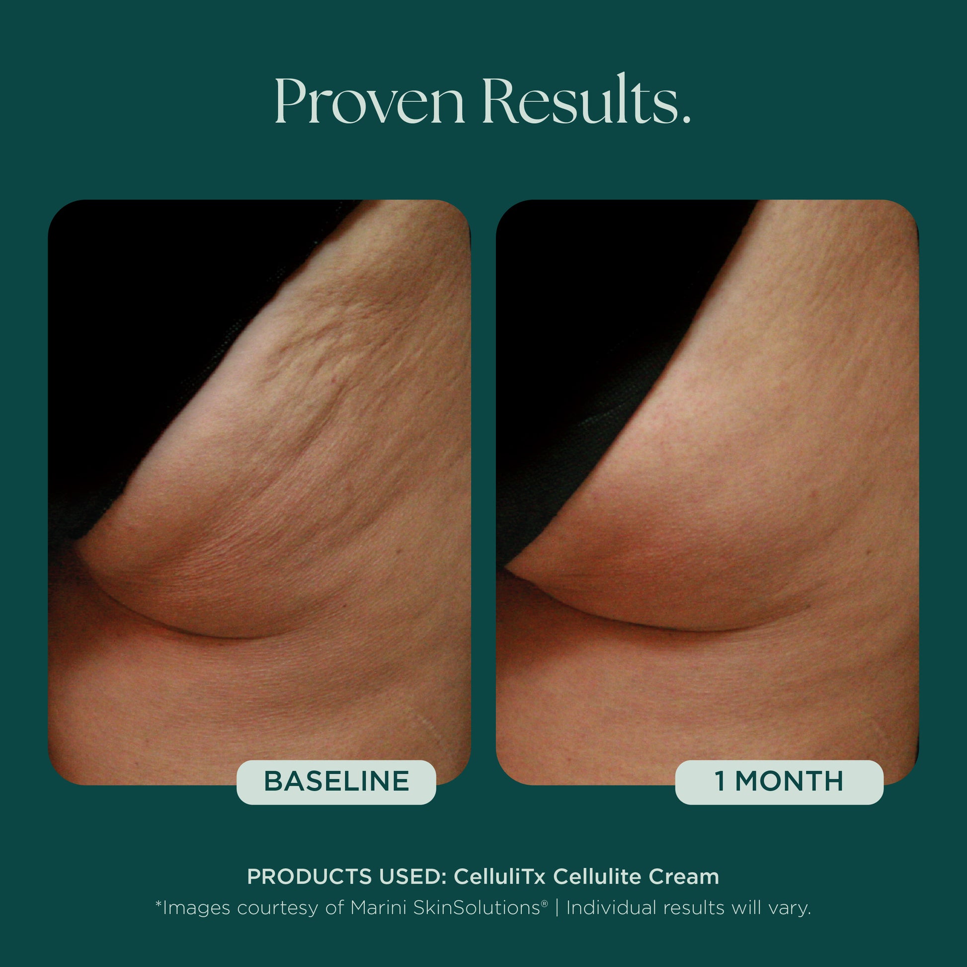 Before and after comparison of cellulite treatment with 1 month results. Clinically proven skin care product used: CelluliTX Cellulite Body Cream from Marini SkinSolutions