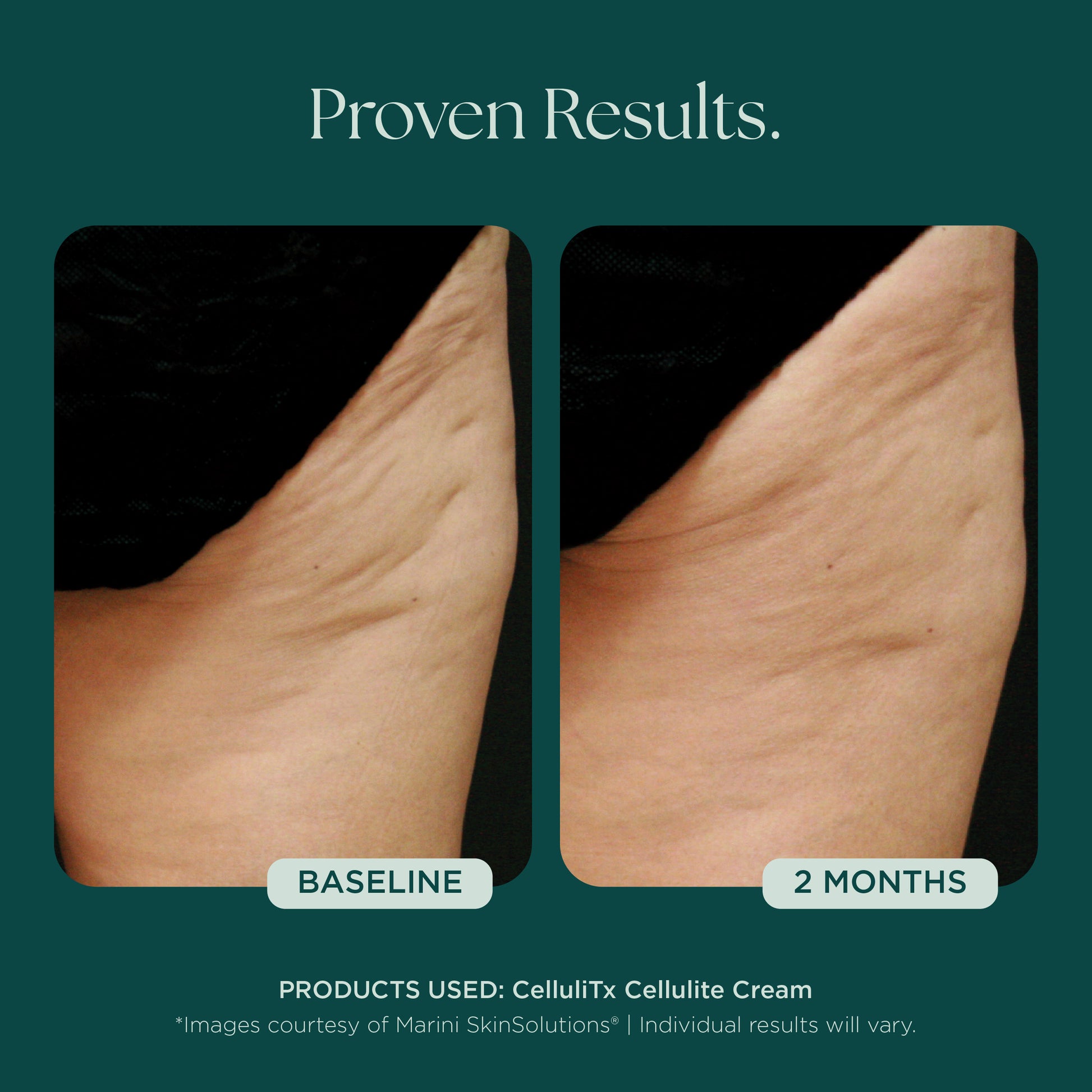 Before and after comparison of cellulite treatment with 2 month results. Clinically proven medical grade skin care product used: CelluliTX Cellulite Cream from Marini SkinSolutions