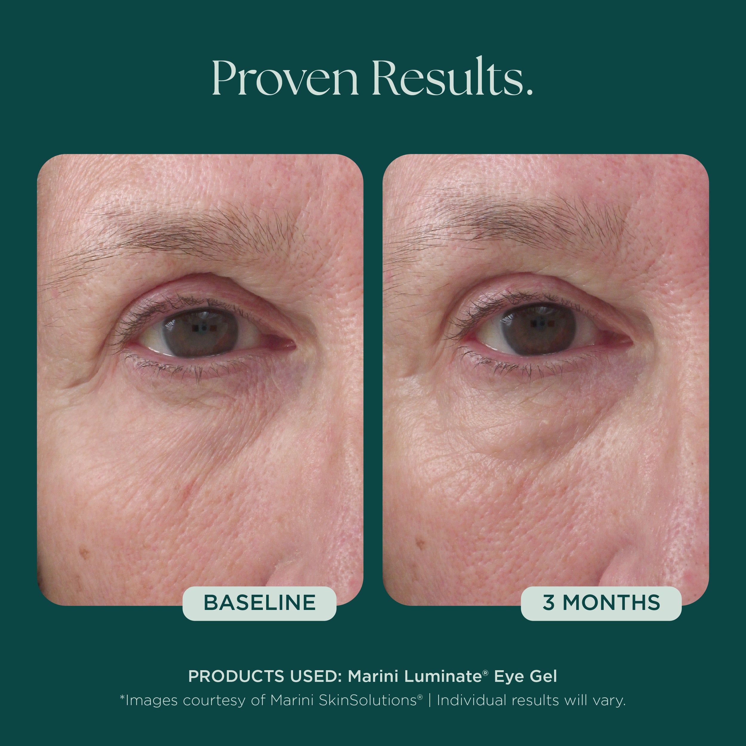 Marini Luminate® Eye Gel | Brighten Under Eye Circles & Eye Bags