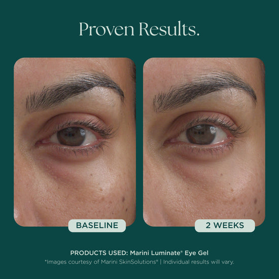 Before and after comparison of eye gel treatment with visible reduction of dark circles under eyes, eye bags, and eye wrinkles. Medical grade skin care used: Marini Luminate Eye Gel from Marini SkinSolutions