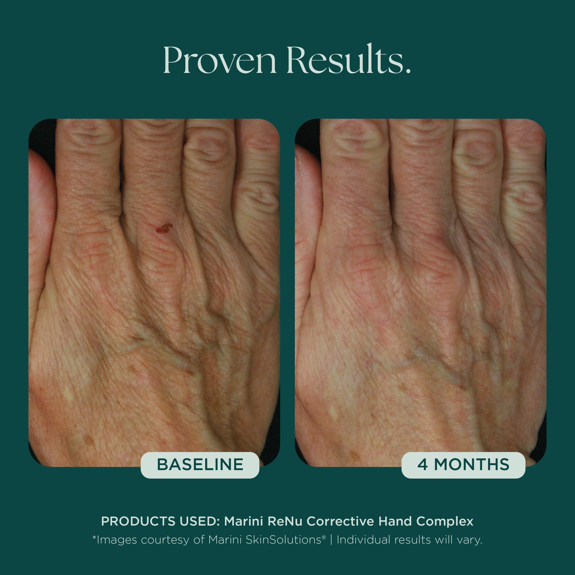 Before and After Photo Results of Anti-Aging Hand Treatment. Clinically proven skin care for hand wrinkles, hand discoloration, and hand aging. Product used: Marini ReNu Corrective Hand Complex from Marini SkinSolutions