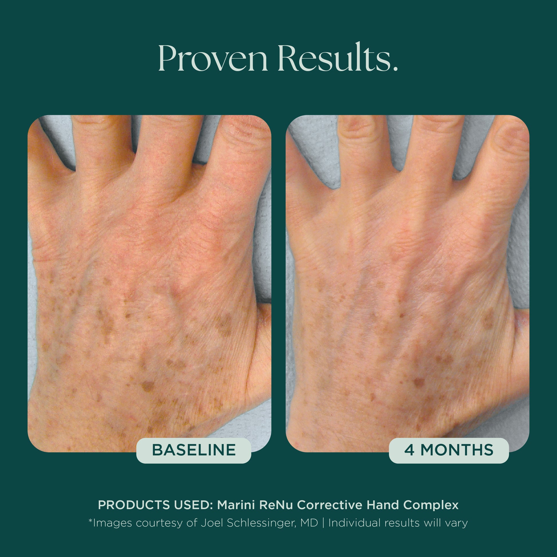 Before and After Photo Results of Anti-Aging Hand Treatment. Clinically proven skin care for hand wrinkles, hand discoloration, and hand aging. Product used: Marini ReNu Corrective Hand Complex from Marini SkinSolutions