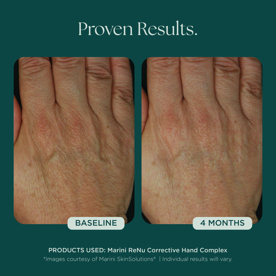 Before and After Photo Results of Anti-Aging Hand Treatment. Clinically proven skin care for hand wrinkles, hand discoloration, and hand aging. Product used: Marini ReNu Corrective Hand Complex from Marini SkinSolutions