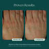 Before and After Photo Results of Anti-Aging Hand Treatment. Clinically proven skin care for hand wrinkles, hand discoloration, and hand aging. Product used: Marini ReNu Corrective Hand Complex from Marini SkinSolutions