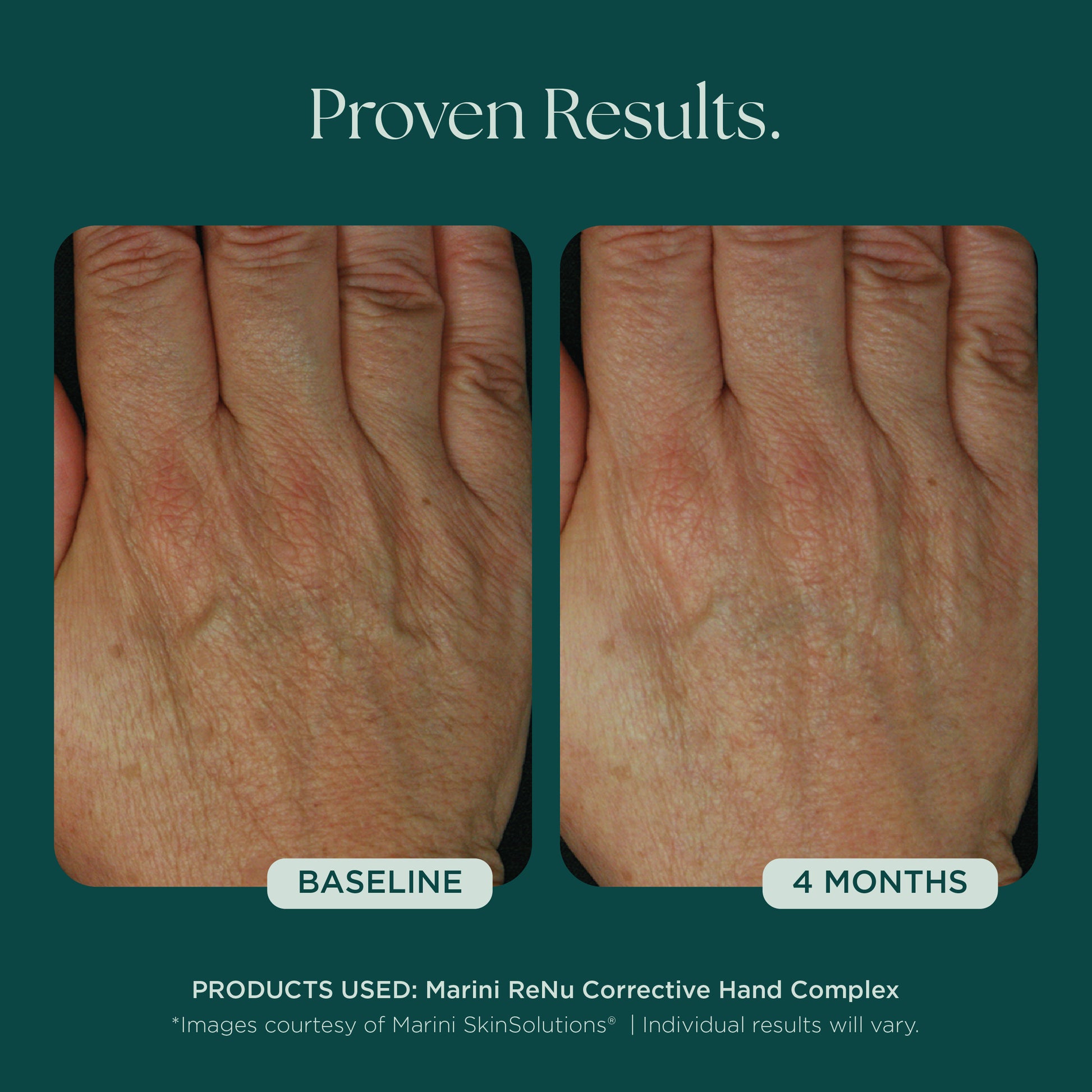 Before and After Photo Results of Anti-Aging Hand Treatment. Clinically proven skin care for hand wrinkles, hand discoloration, and hand aging. Product used: Marini ReNu Corrective Hand Complex from Marini SkinSolutions