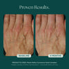 Before and After Photo Results of Anti-Aging Hand Treatment. Clinically proven skin care for hand wrinkles, hand discoloration, and hand aging. Product used: Marini ReNu Corrective Hand Complex from Marini SkinSolutions