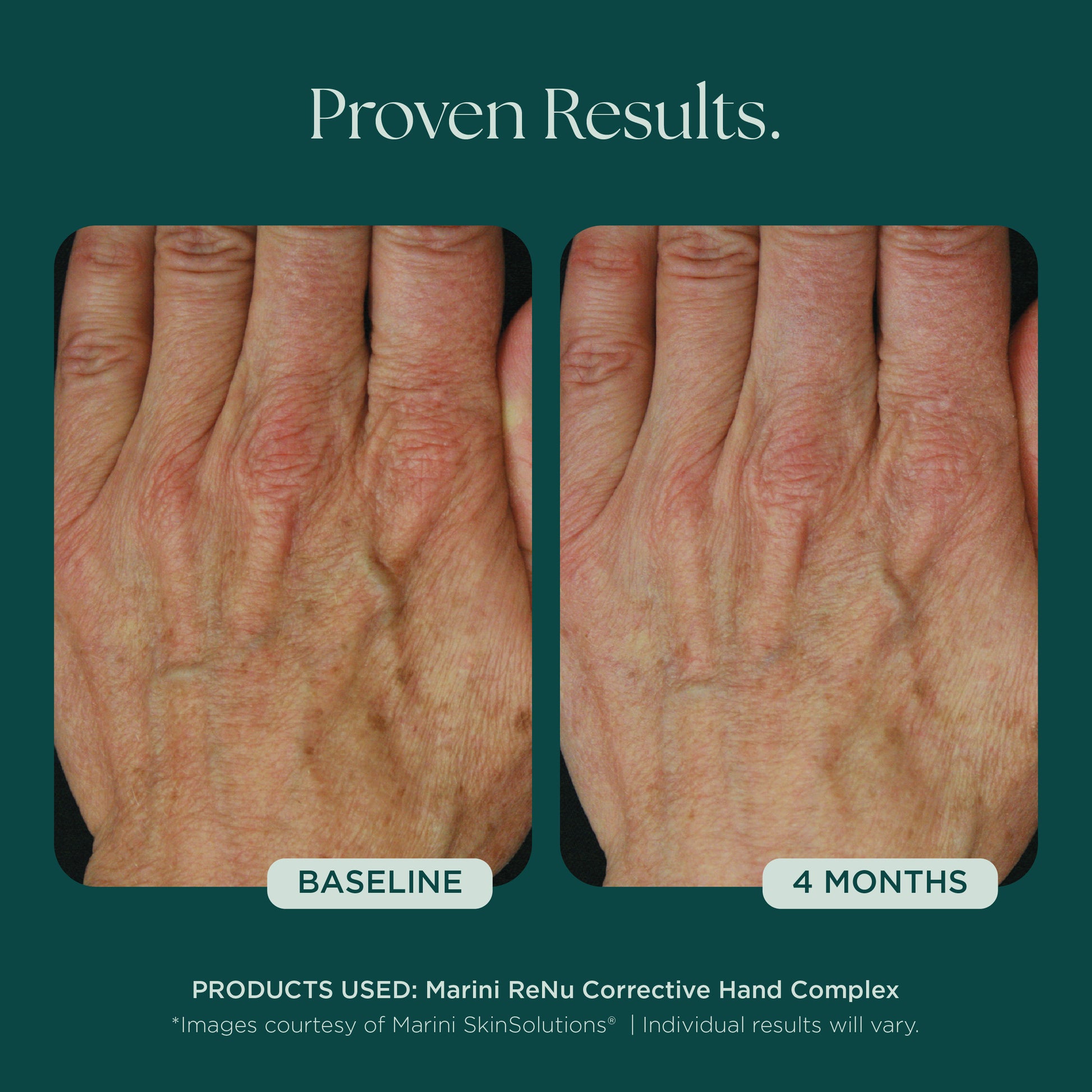 Before and After Photo Results of Anti-Aging Hand Treatment. Clinically proven skin care for hand wrinkles, hand discoloration, and hand aging. Product used: Marini ReNu Corrective Hand Complex from Marini SkinSolutions
