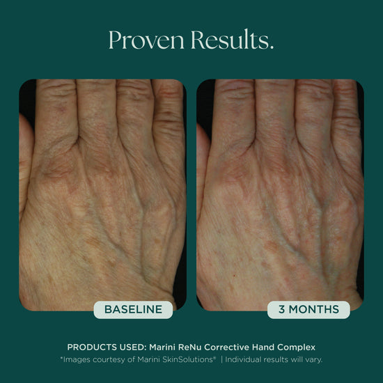 Before and After Photo Results of Anti-Aging Hand Treatment. Clinically proven skin care for hand wrinkles, hand discoloration, and hand aging. Product used: Marini ReNu Corrective Hand Complex from Marini SkinSolutions