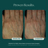 Before and After Photo Results of Anti-Aging Hand Treatment. Clinically proven skin care for hand wrinkles, hand discoloration, and hand aging. Product used: Marini ReNu Corrective Hand Complex from Marini SkinSolutions