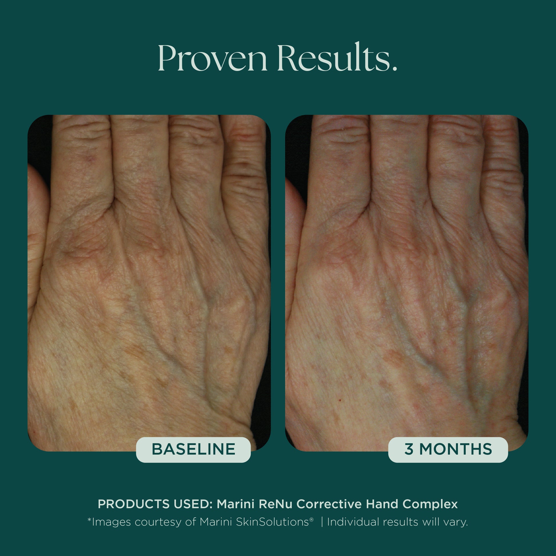 Before and After Photo Results of Anti-Aging Hand Treatment. Clinically proven skin care for hand wrinkles, hand discoloration, and hand aging. Product used: Marini ReNu Corrective Hand Complex from Marini SkinSolutions