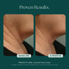 Before and after comparison of neck skin with Juveneck Neck Cream from Marini SkinSolutions, showing visible and clinically results over 6 months.