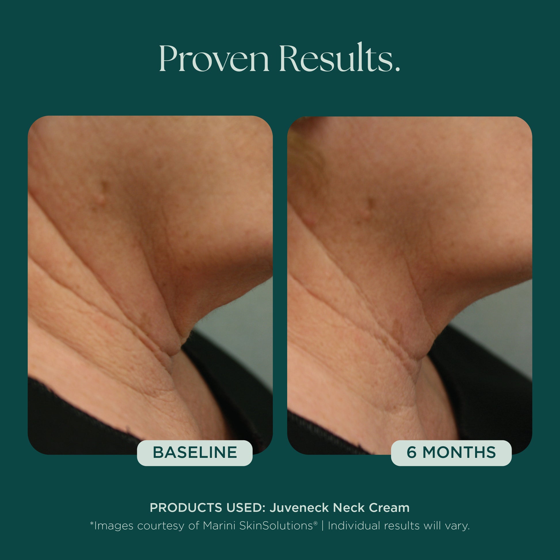 Before and after comparison of neck skin with Juveneck Neck Cream from Marini SkinSolutions, showing visible and clinically results over 6 months.