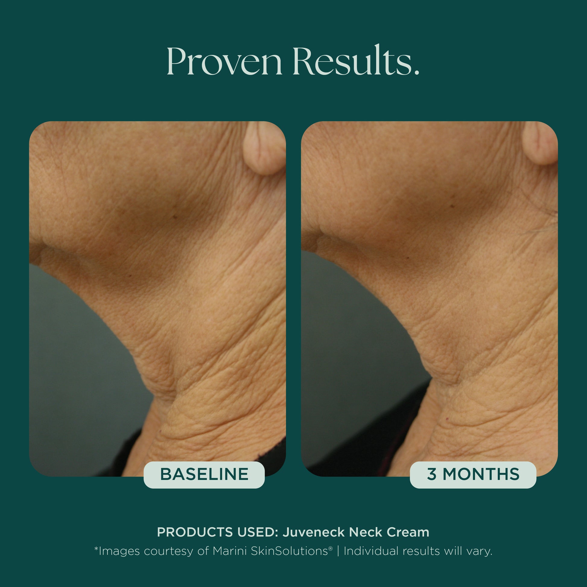 Before and after comparison of neck skin texture with Juveneck Neck Cream from Marini SkinSolutions, showing visible improvement over 3 months.