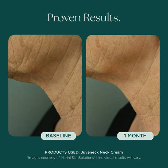 Before and after comparison of neck skin texture with Juveneck Neck Cream from Marini SkinSolutions. Proven clinical results of decreasing the appearance of neck lines, neck wrinkles, neck discoloration, and neck laxity.