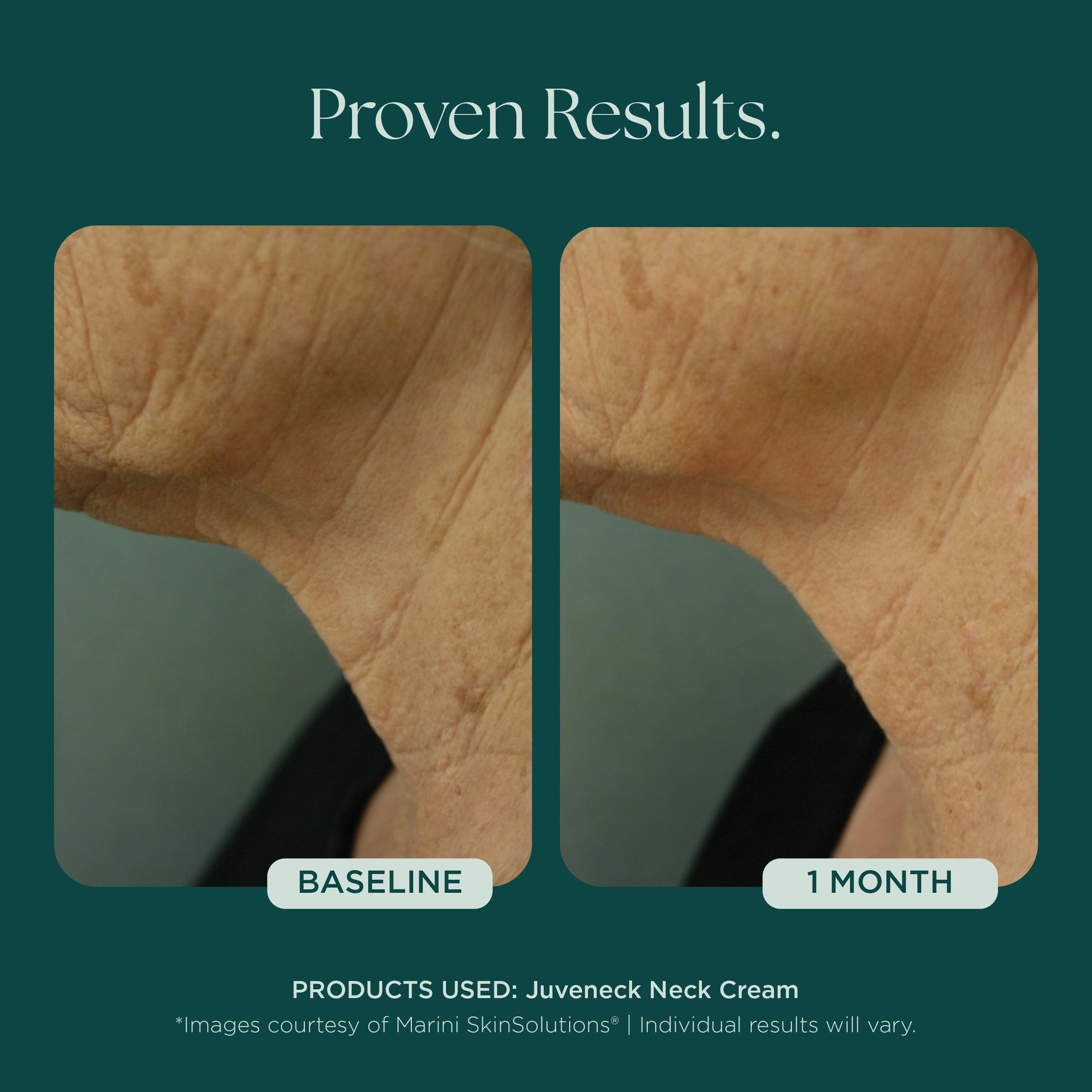 Before and after comparison of neck skin texture with Juveneck Neck Cream from Marini SkinSolutions. Proven clinical results of decreasing the appearance of neck lines, neck wrinkles, neck discoloration, and neck laxity.