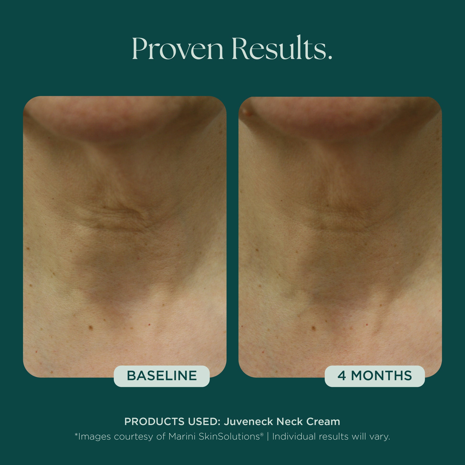 Before and after comparison of neck skin with Juveneck Neck Cream from Marini SkinSolutions. Reduce the appearance of neck wrinkles and neck skin laxity with proven clinical results.