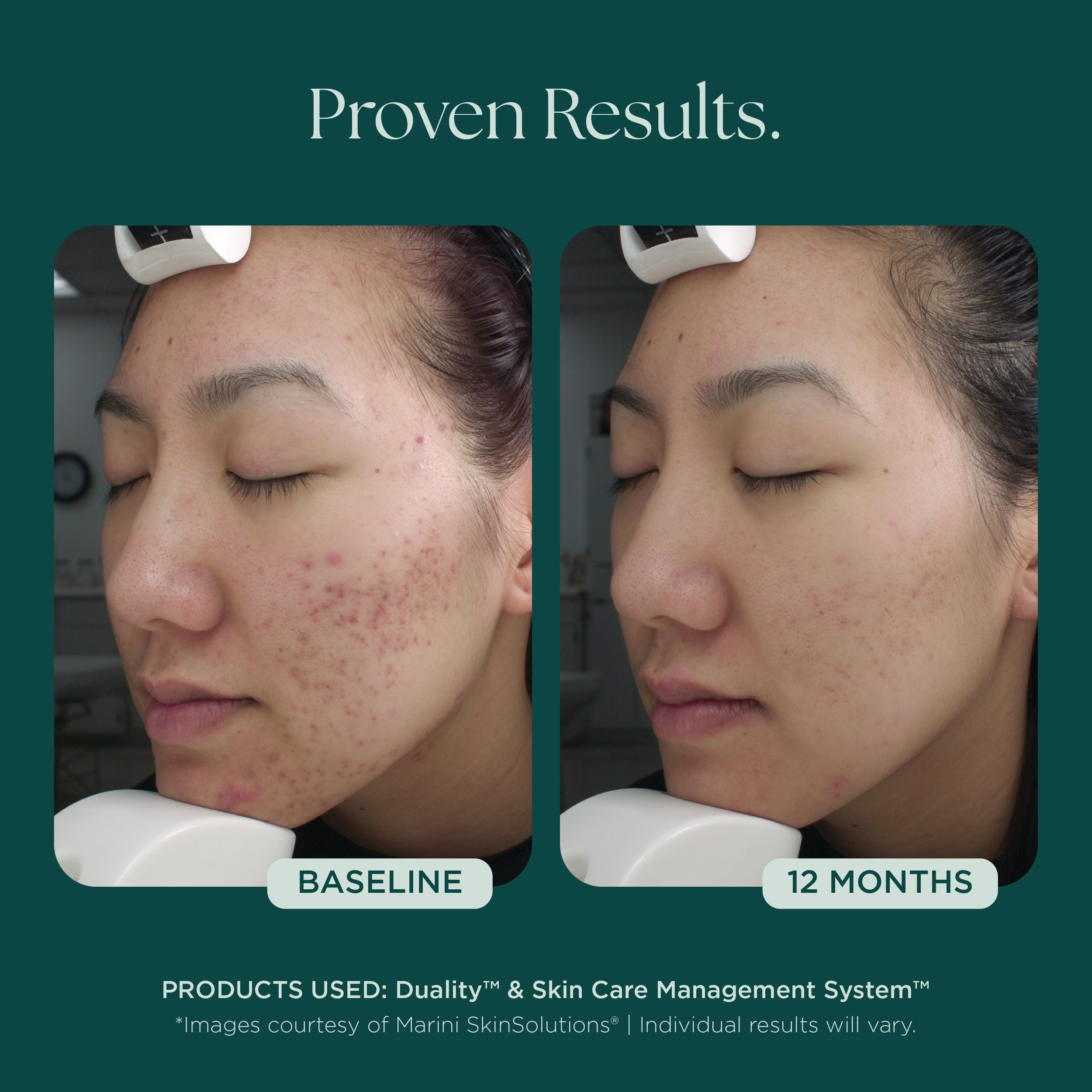 Duality™ Acne Treatment | Benzoyl Peroxide & Retinol Skin Care