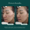 Before and after comparison of a person's face with acne treatment results. Clinically proven skin care products used: Duality Acne Treatment and Skin Care Management System from Marini SkinSolutions