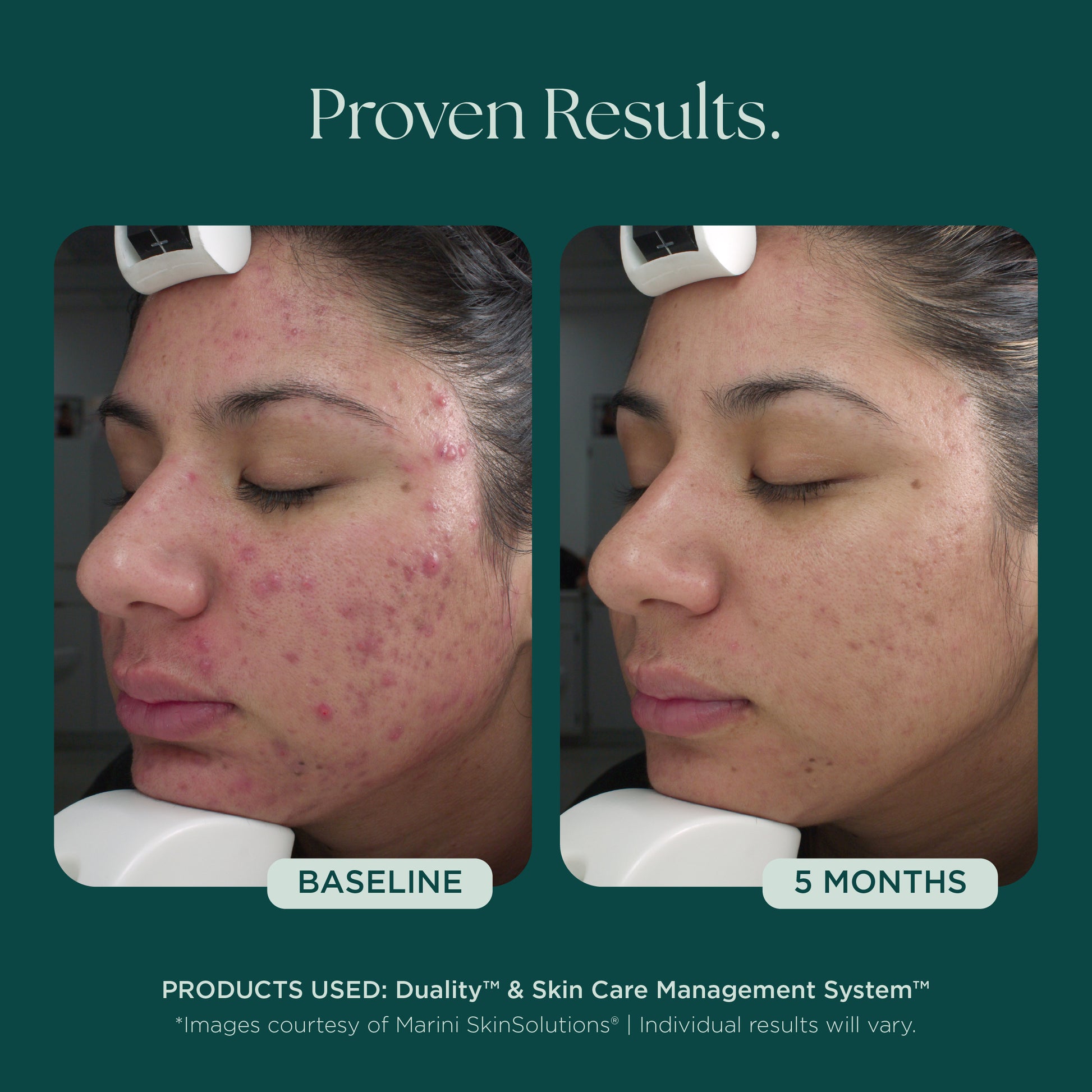 Before and after comparison of a person's face with acne treatment results over 5 months. Clinically proven skin care products used: Duality Acne Treatment and Skin Care Management System from Marini SkinSolutions