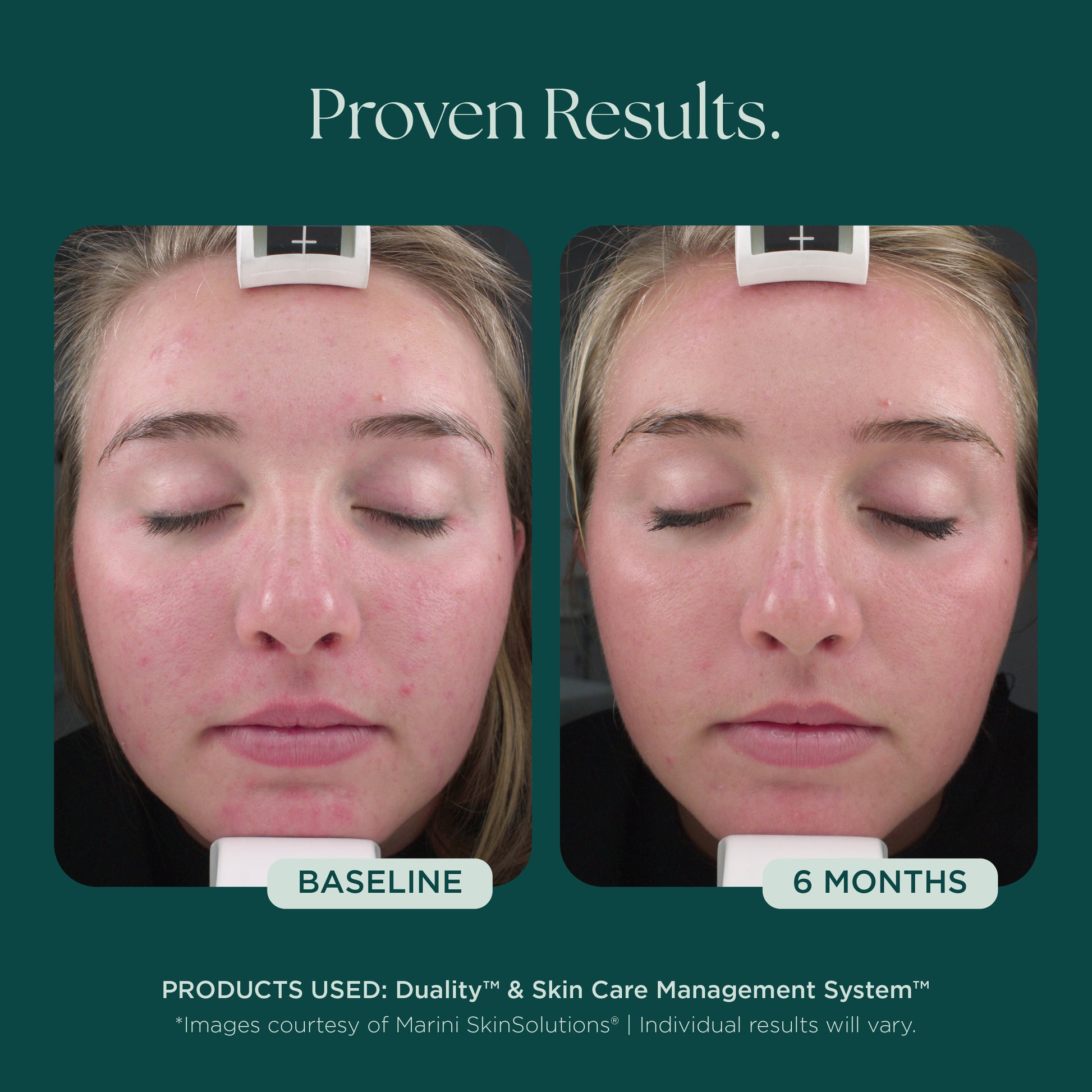 Before and after comparison of a woman's face with acne. Clinically proven skin care products used: Duality Acne Treatment and Skin Care Management System from Marini SkinSolutions