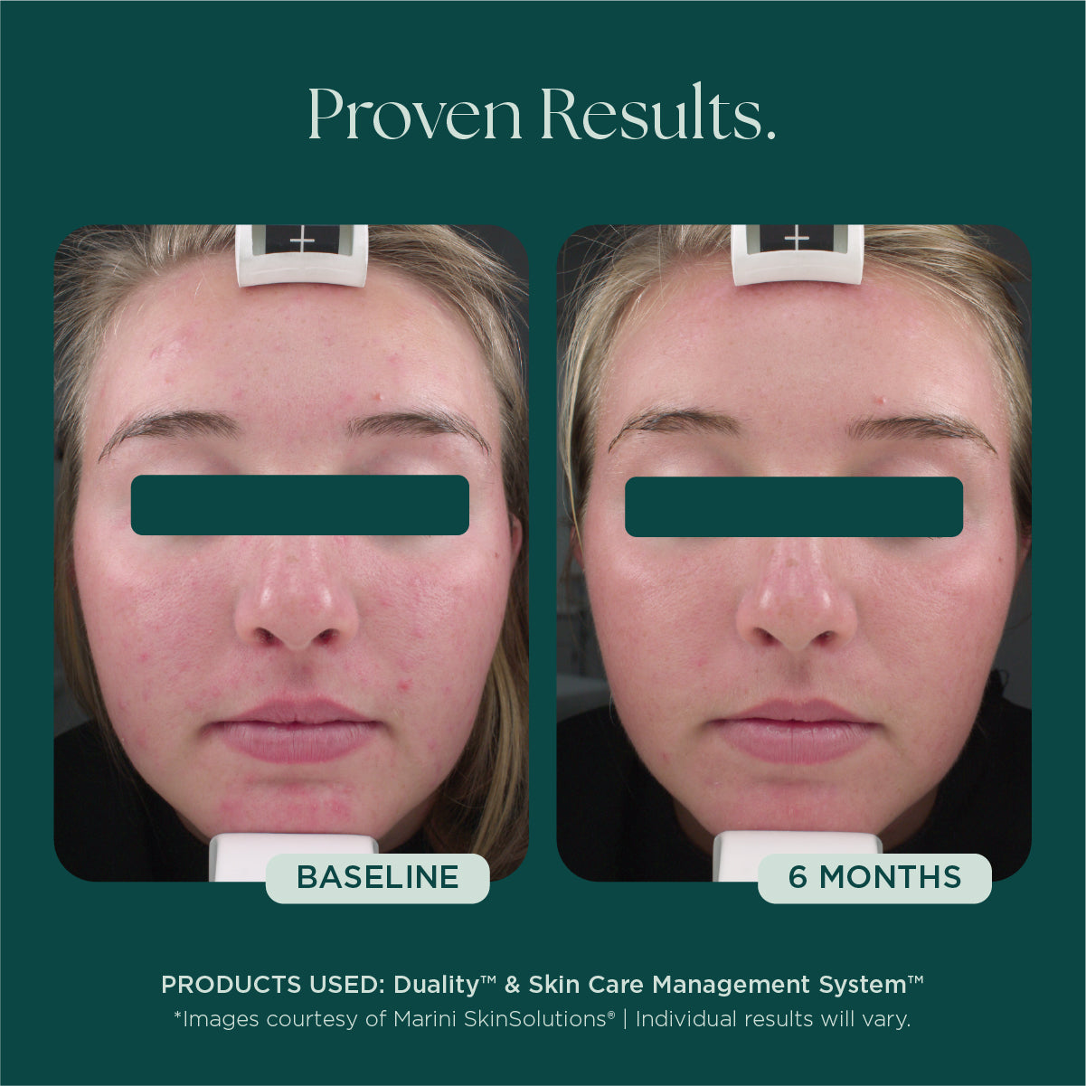 Duality™ Acne Treatment | Benzoyl Peroxide & Retinol Skin Care