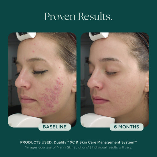 Before and after comparison of a woman's face with acne treatment, showing 'Baseline' and '6 Months' results. Clinically proven skin care products used: Duality Acne Treatment and Skin Care Management System from Marini SkinSolutions