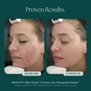Before and after comparison of a woman's face with acne treatment, showing 'Baseline' and '6 Months' results. Clinically proven skin care products used: Duality Acne Treatment and Skin Care Management System from Marini SkinSolutions