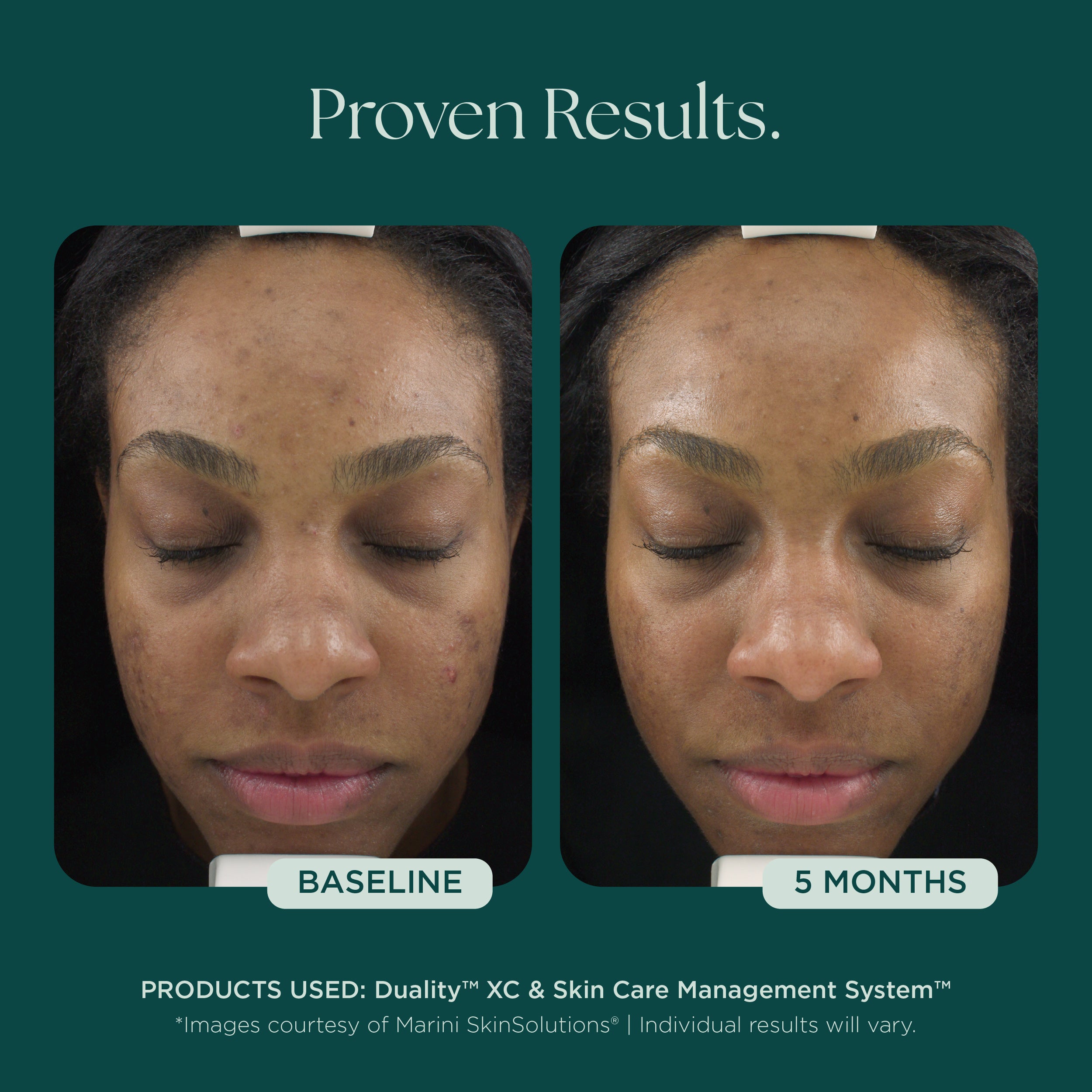 Duality™ Acne Treatment | Benzoyl Peroxide & Retinol Skin Care