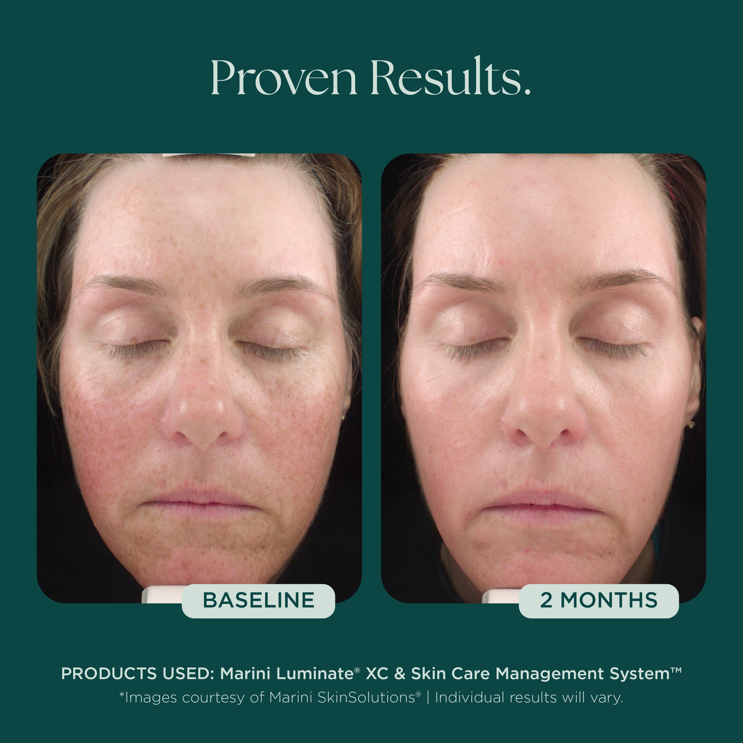 Marini Luminate® Face Lotion for Discoloration & Hyperpigmentation