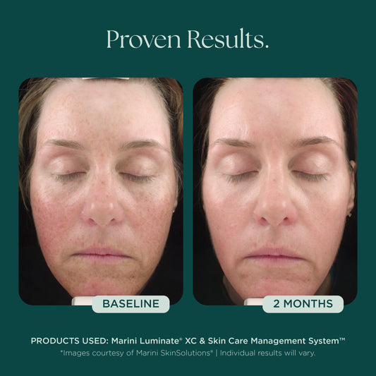 Before and After photo comparison using medical grade skin care Marini Luminate from Marini SkinSolutions. This anti-aging face serum is proven for those with discoloration, dark spots, sun spots, hyperpigmentation.
