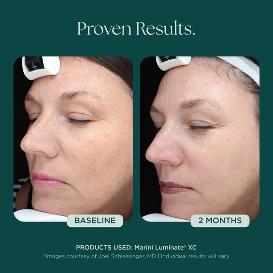 Before and After photo comparison using medical grade skin care Marini Luminate from Marini SkinSolutions. This anti-aging face serum is proven for those with discoloration, dark spots, sun spots, hyperpigmentation.