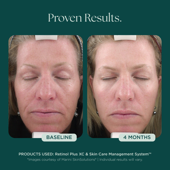 Before and after comparison of a woman's face indicating 4 months of proven clinical results of using Retinol Plus face cream from Marini SkinSolutions.
