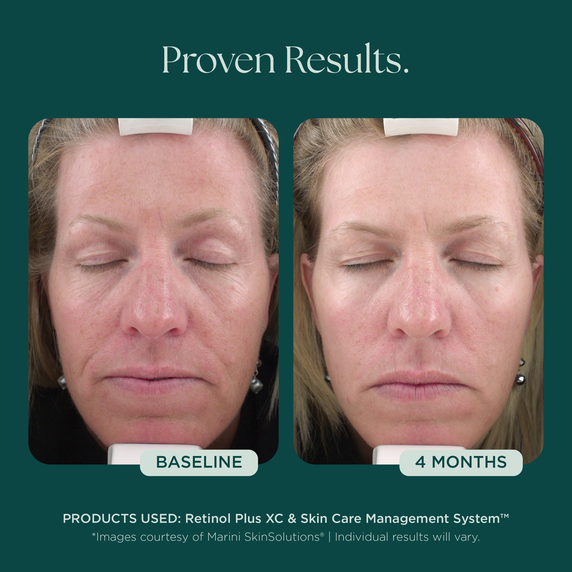 Before and after comparison of a woman's face indicating 4 months of proven clinical results of using Retinol Plus face cream from Marini SkinSolutions.