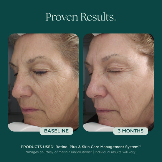 Before and after comparison of a woman's face using medical grade skin care for anti-aging, wrinkle, and fine lines. This woman shows proven visible results at 3 months using Retinol Plus skin care from Marini SkinSolutions.