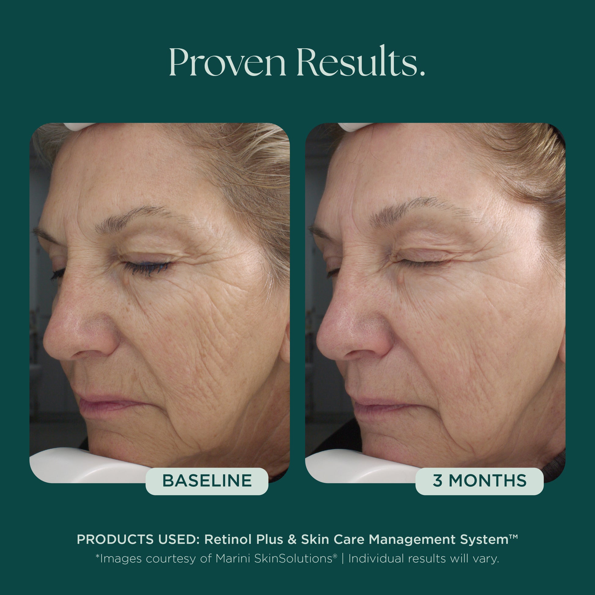 Before and after comparison of a woman's face using medical grade skin care for anti-aging, wrinkle, and fine lines. This woman shows proven visible results at 3 months using Retinol Plus skin care from Marini SkinSolutions.