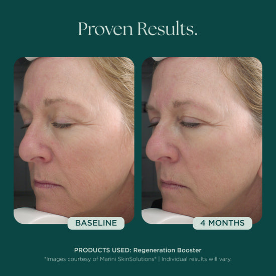 Before and after comparison of a woman's face with text indicating 'Proven Results' and '4 Months' with consistent use of Regeneration Booster, a patented and proven anti-aging face serum from Marini SkinSolutions.