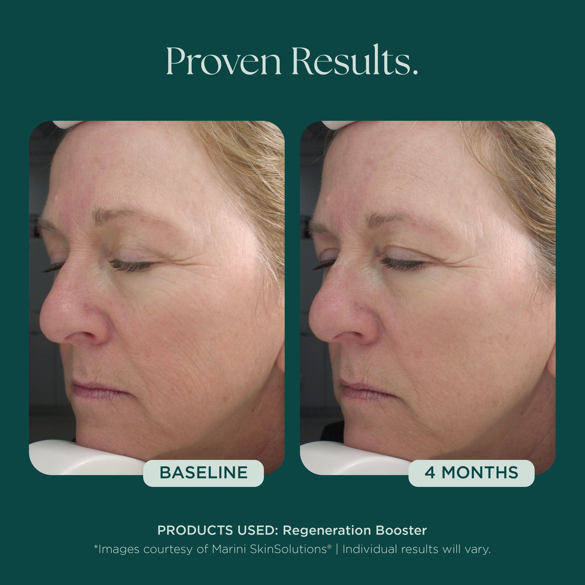 Before and after comparison of a woman's face with text indicating 'Proven Results' and '4 Months' with consistent use of Regeneration Booster, a patented and proven anti-aging face serum from Marini SkinSolutions.