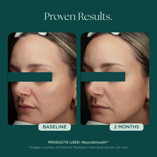 Before and after comparison of a woman's face with only 2 months to show visible proven results. She used NeuroSmooth glass skin face serum by Marini SkinSolutions.