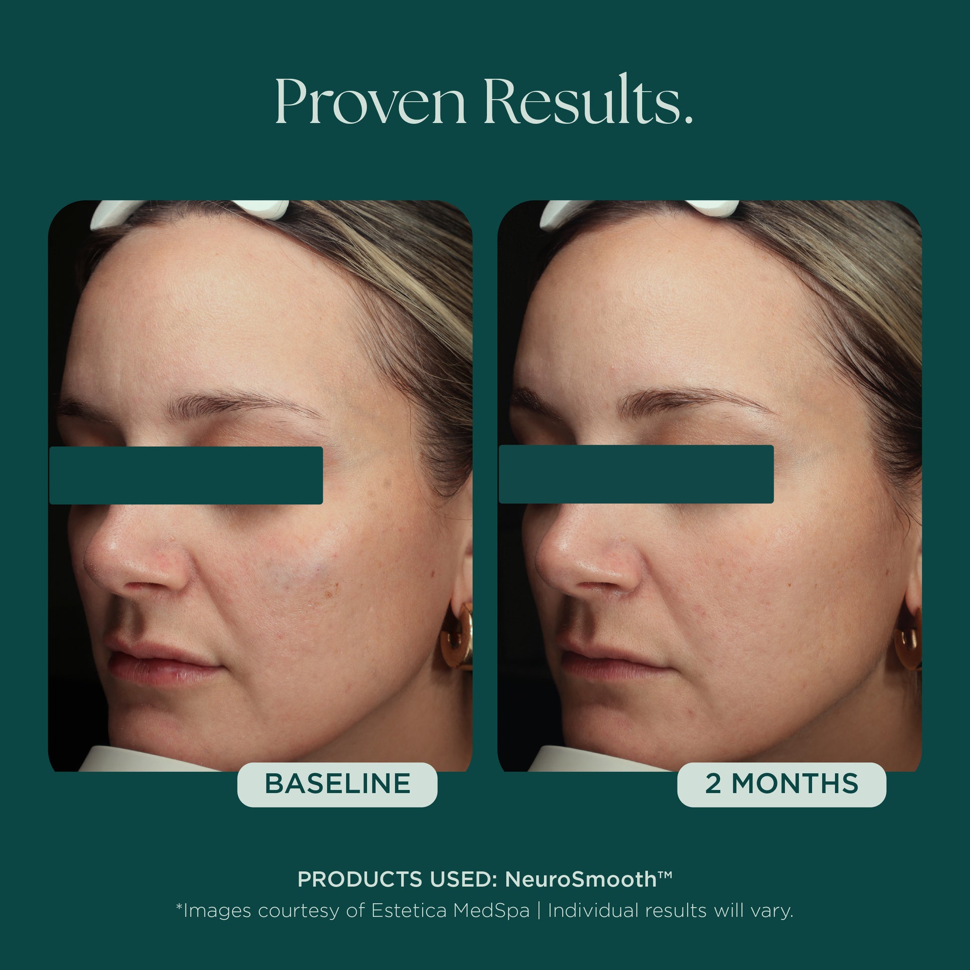 Before and after comparison of a woman's face with only 2 months to show visible proven results. She used NeuroSmooth glass skin face serum by Marini SkinSolutions.