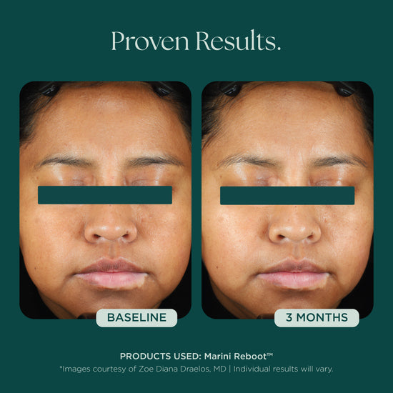 Before and after comparison of a woman's face with text indicating 'Proven Results' and '3 Months' using Marini Reboot PDRN Face Serum from Marini SkinSolutions.