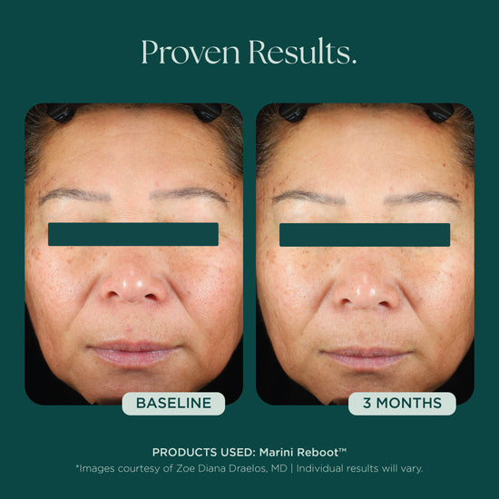 Marini Reboot is one of the first PDRN solutions in the professional market designed with highly concentrated PDRN, plus advanced rejuvenation and prejuvenation technologies for total skin longevity.