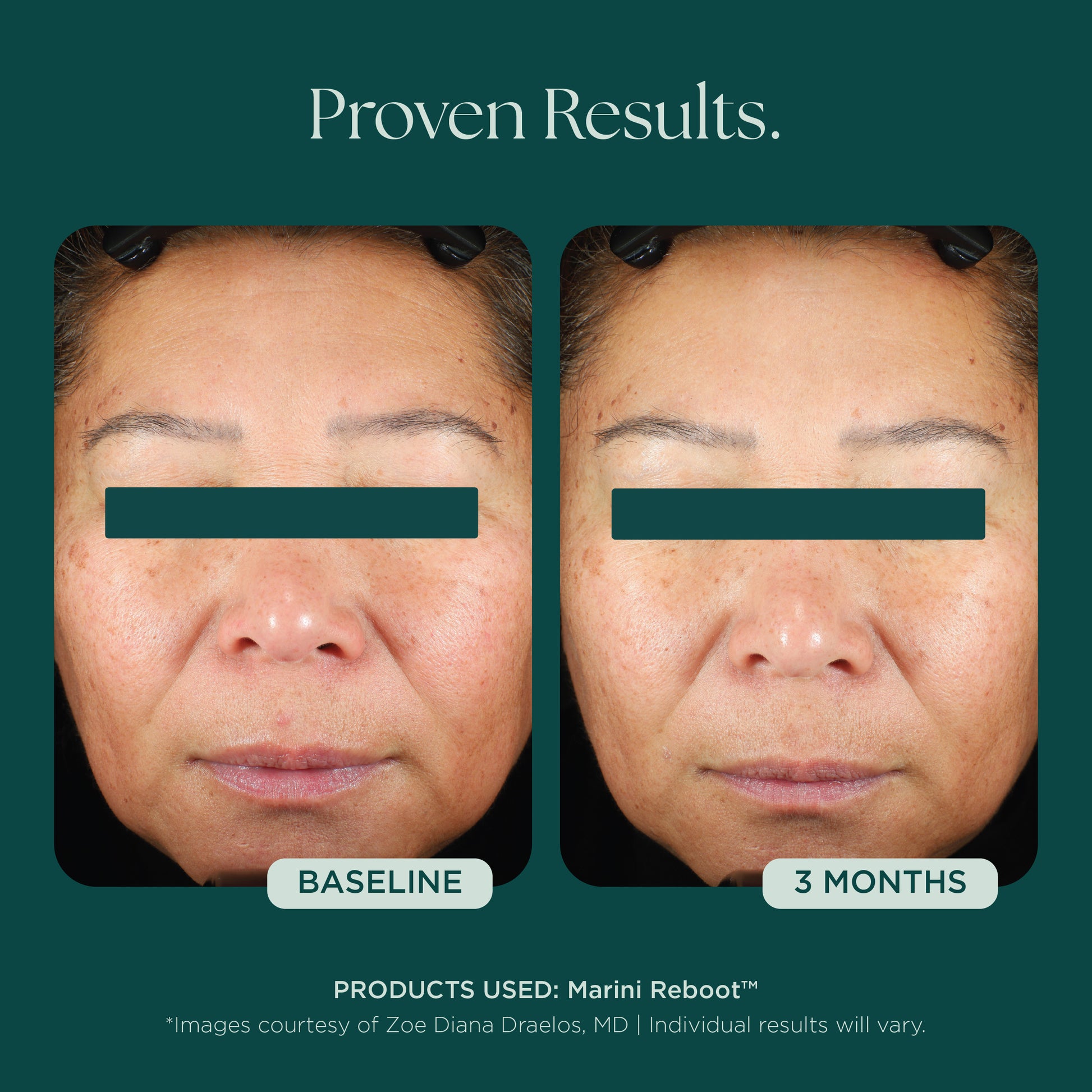 Marini Reboot is one of the first PDRN solutions in the professional market designed with highly concentrated PDRN, plus advanced rejuvenation and prejuvenation technologies for total skin longevity.